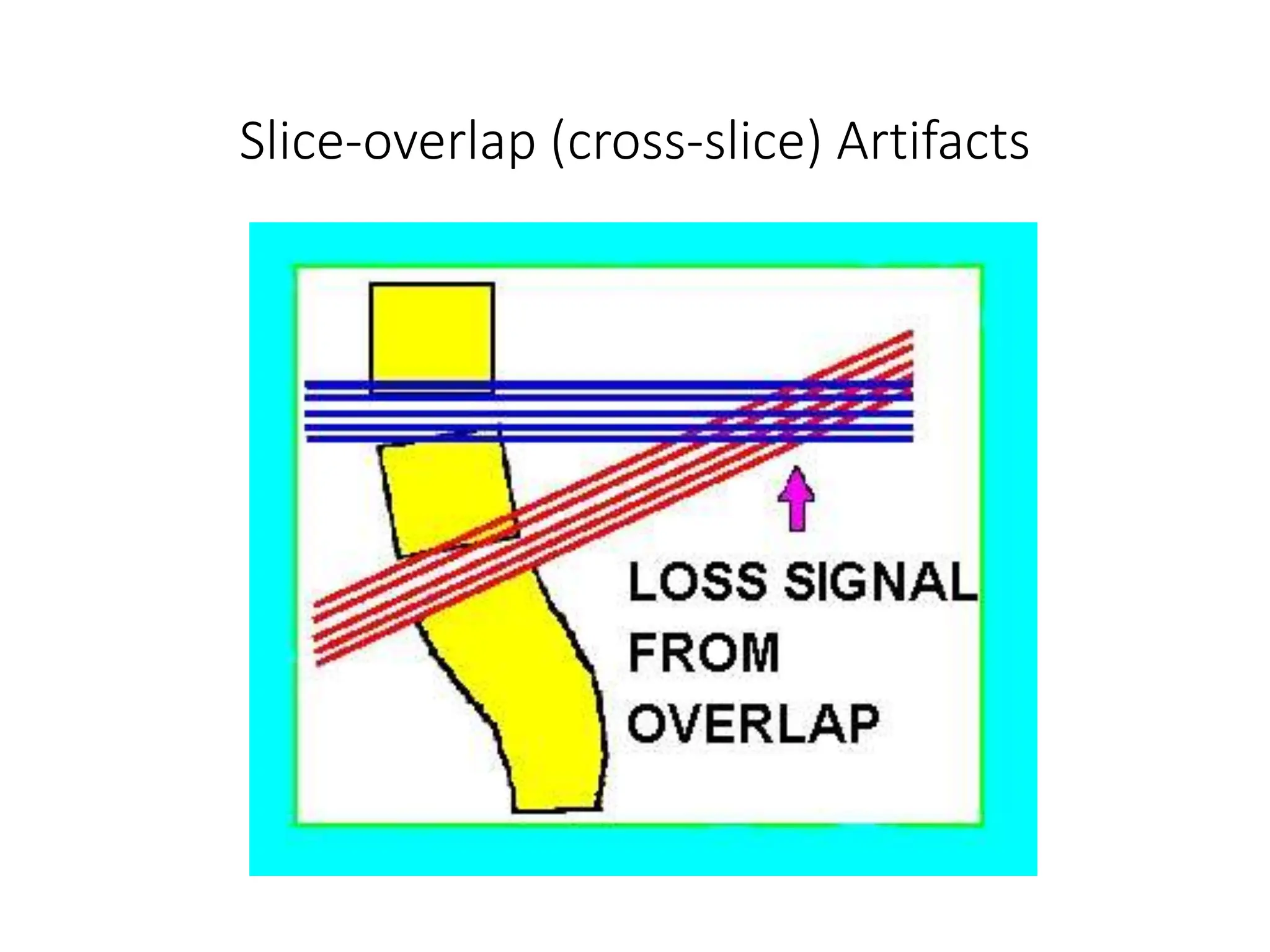 Slice-overlap (cross-slice) Artifacts
 