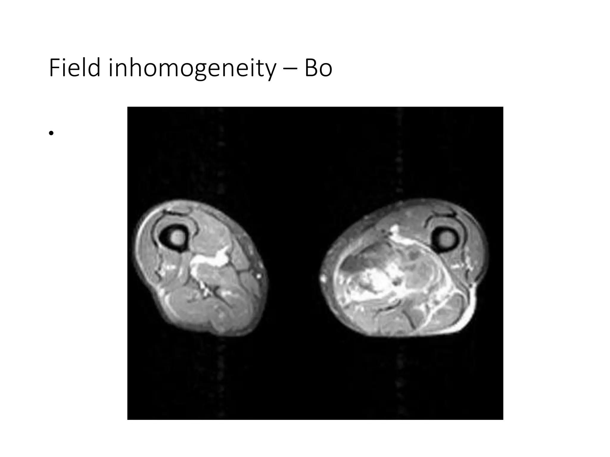 Field inhomogeneity – Bo
•
 