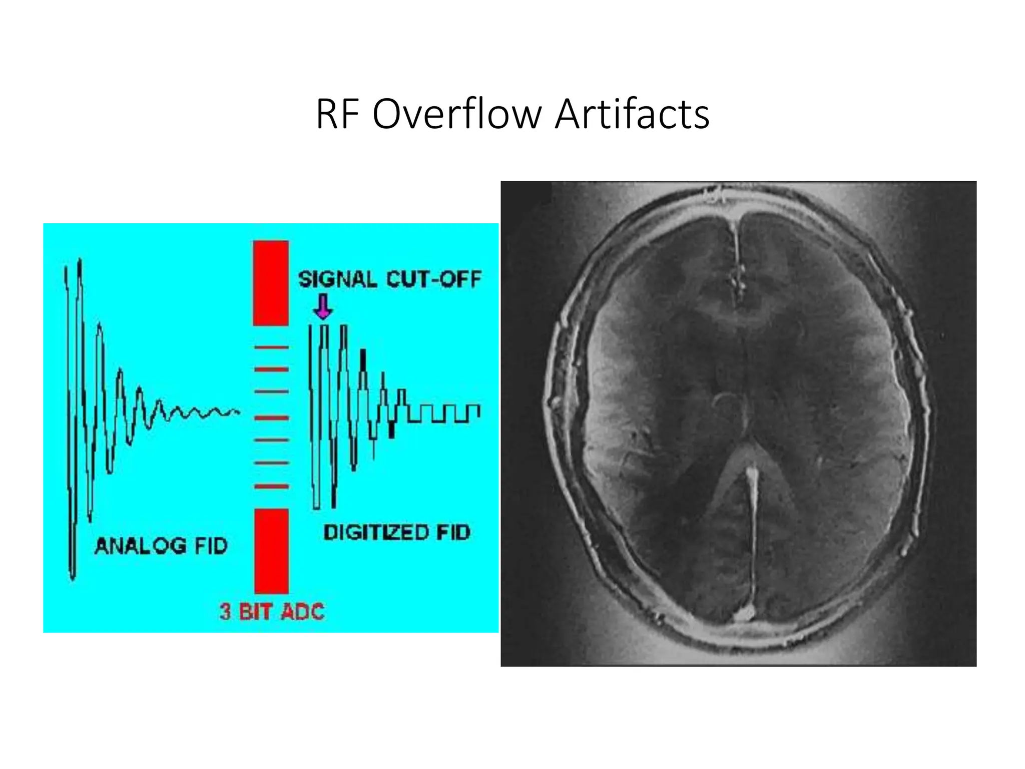 RF Overflow Artifacts
 