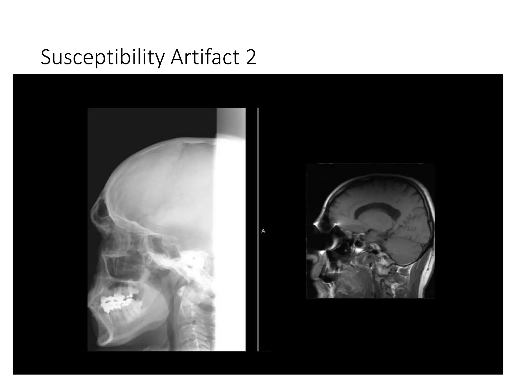 Susceptibility Artifact 2
 