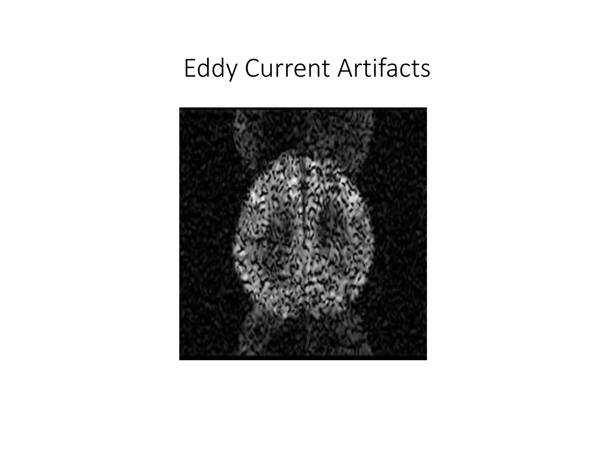 Eddy Current Artifacts
 