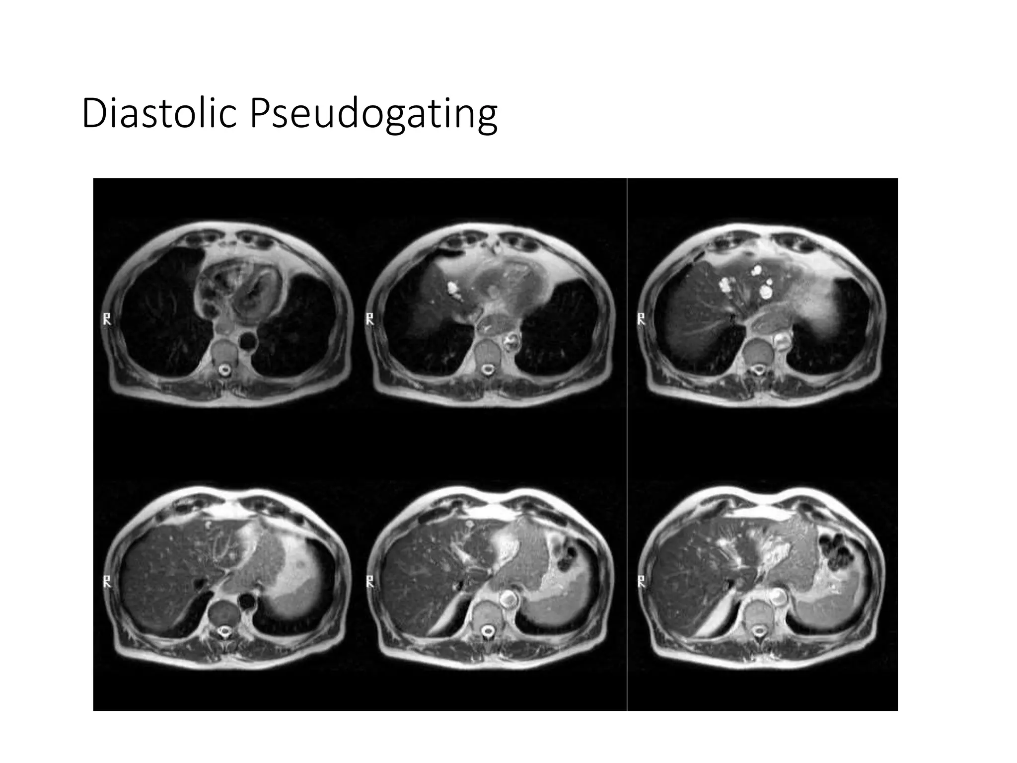 Diastolic Pseudogating
 