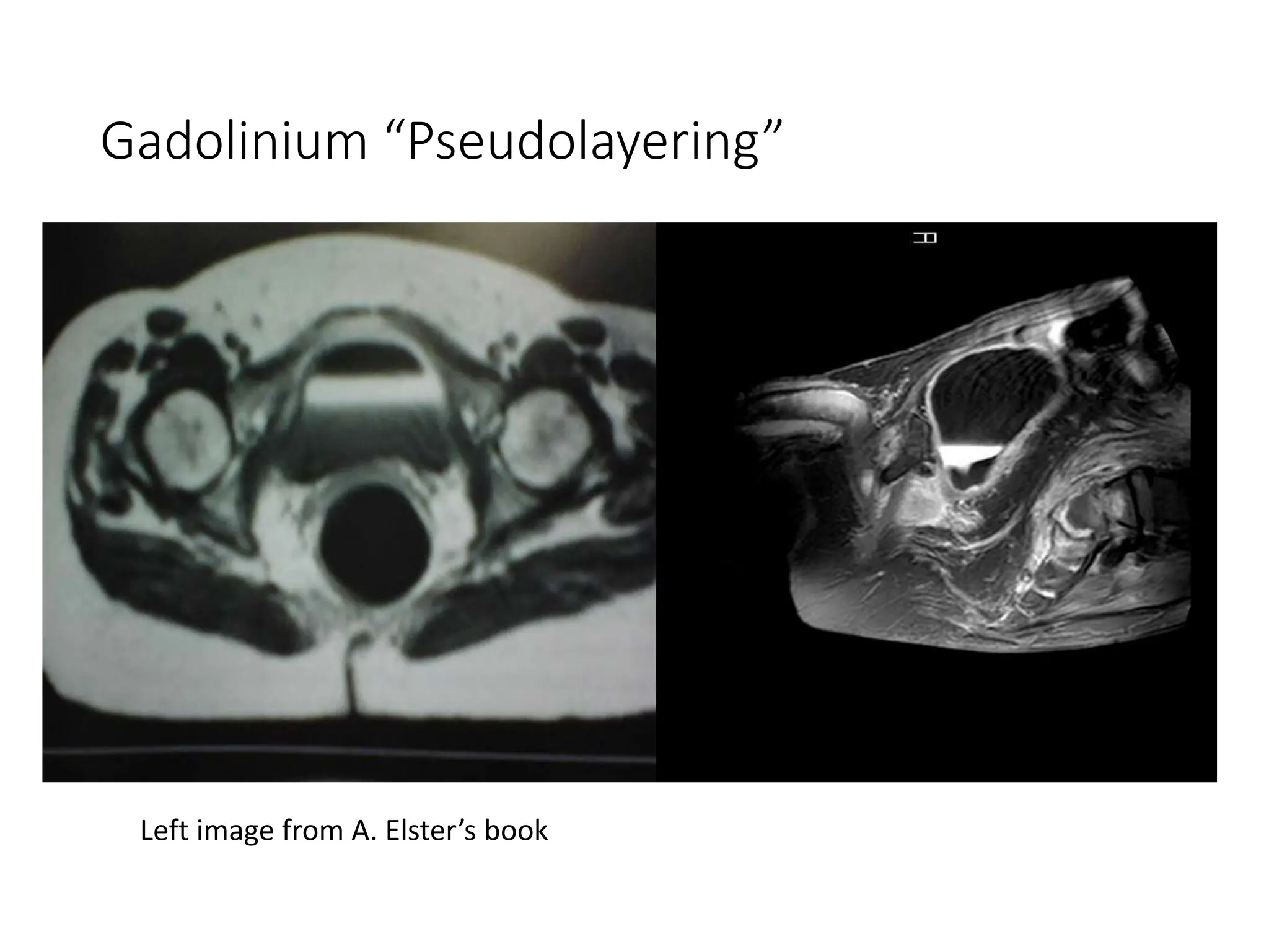 Gadolinium “Pseudolayering”
Left image from A. Elster’s book
 