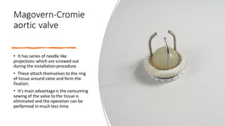 Magovern-Cromie
aortic valve
• It has series of needle like
projections which are screwed out
during the installation procedure.
• These attach themselves to the ring
of tissue around valve and form the
fixation.
• It's main advantageis the consuming
sewing of the valve to the tissue is
eliminated and the operation can be
performed in much less time.
 