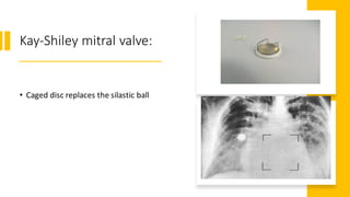 Kay-Shiley mitral valve:
• Caged disc replaces the silastic ball
 