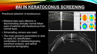#AI IN KERATOCONUS SCREENING
Preclinical detection of keratoconus-
• Bilateral data were effective in
discriminating clinically normal fellow
eyes of patients with keratoconus from
normal eyes.
• Scheimpflug camera was used.
• The most sensitive parameters to date
for early KC identification -
combination of videokeratography,
wavefront analysis, and optical
coherence tomography.
.
11
 