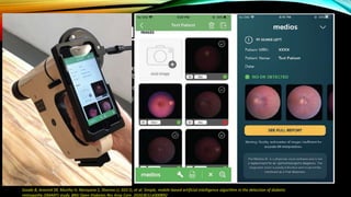 MEDIOS-AI FOR DR ON SMART
PHONE
• A study looking into 900 adult subjects with diabetes in India, where five retinal specialists graded
images taken with the Remidio mobile camera for any DR or rDR.
• This was later compared to the Medios AI software running offline on an Iphone 6
• Medios AI achieved good results with sensitivity and specificity pair for any DR of 83.3% and 95.5%
and for rDR 93% and 92.5%
Sosale B, Aravind SR, Murthy H, Narayana S, Sharma U, SGV G, et al. Simple, mobile-based artificial intelligence algorithm in the detection of diabetic
retinopathy (SMART) study. BMJ Open Diabetes Res Amp Care. 2020;8(1):e000892
35
 