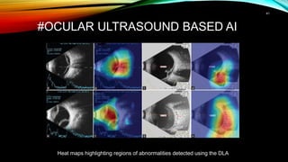 #OCULAR ULTRASOUND BASED AI
41
Heat maps highlighting regions of abnormalities detected using the DLA
 
