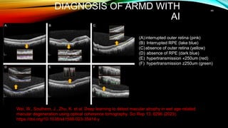 DIAGNOSIS OF ARMD WITH
AI
44
(A) interrupted outer retina (pink)
(B) Interrupted RPE (lake blue)
(C)absence of outer retina (yellow)
(D) absence of RPE (dark blue)
(E) hypertransmission «250um (red)
(F) hypertransmission z250um (green)
Wei, W., Southern, J., Zhu, K. et al. Deep learning to detect macular atrophy in wet age-related
macular degeneration using optical coherence tomography. Sci Rep 13, 8296 (2023).
https://doi.org/10.1038/s41598-023-35414-y
 