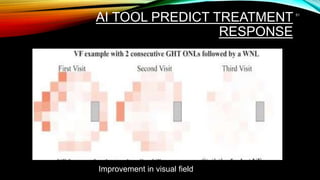 AI TOOL PREDICT TREATMENT
RESPONSE
51
Improvement in visual field
 