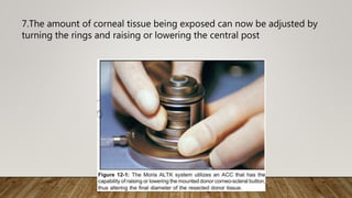 7.The amount of corneal tissue being exposed can now be adjusted by
turning the rings and raising or lowering the central post
 