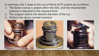In summary, the 3 steps to the use of Moria ALTK system are as follows
1. The donor cornea is sealed within the AAC, and the intrachamber
pressure is adjusted to the required level.
2. The surgeon selects the desired diameter of the cut.
3. Perform the donor corneal resection
 