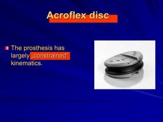 Acroflex disc
The prosthesis has
largely „constrained“
kinematics.
 