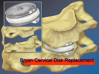 Bryan Cervical Disk Replacement
 