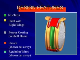 DESIGN FEATURES
Shell with
Rigid Wings
Sheath
(shown cut away)
Retaining Wires
(shown cut away)
Nucleus
Porous Coating
on Shell Dome
 