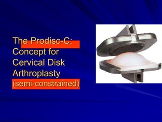 The Prodisc-C:
Concept for
Cervical Disk
Arthroplasty
(semi-constrained)
 