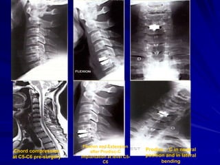 Chord compression
at C5-C6 pre-surgery
Flexion and Extension
after Prodisc-C
implantation at level C5-
C6
Prodisc – C in neutral
position and in lateral
bending
 