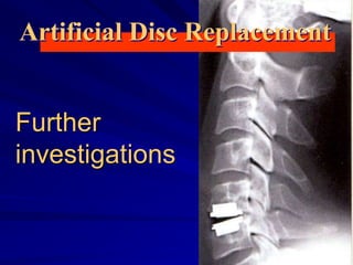 Further
investigations
Artificial Disc Replacement
 