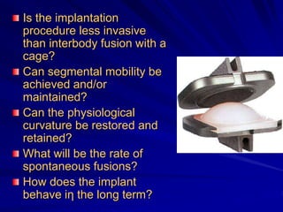 Is the implantation
procedure less invasive
than interbody fusion with a
cage?
Can segmental mobility be
achieved and/or
maintained?
Can the physiological
curvature be restored and
retained?
What will be the rate of
spontaneous fusions?
How does the implant
behave iη the long term?
 