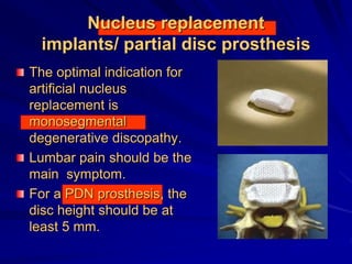 Nucleus replacement
implants/ partial disc prosthesis
The optimal indication for
artificial nucleus
replacement is
monosegmental
degenerative discopathy.
Lumbar pain should be the
main symptom.
For a PDN prosthesis, the
disc height should be at
least 5 mm.
 