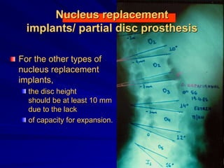 Nucleus replacement
implants/ partial disc prosthesis
For the other types of
nucleus replacement
implants,
the disc height
should be at least 10 mm
due to the lack
of capacity for expansion.
 
