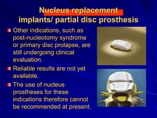 Nucleus replacement
implants/ partial disc prosthesis
Other indications, such as
post-nucleotomy syndrome
or primary disc prolapse, are
still undergoing clinical
evaluation.
Reliable results are not yet
available.
The use of nucleus
prostheses for these
indications therefore cannot
be recommended at present.
 