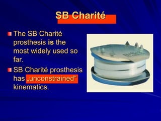 SB Charité
The SB Charité
prosthesis is the
most widely used so
far.
SB Charité prosthesis
has „unconstrained“
kinematics.
 
