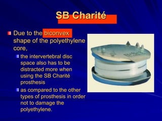 SB Charité
Due to the biconvex
shape of the polyethylene
core,
the intervertebral disc
space also has to be
distracted more when
using the SB Charité
prosthesis
as compared to the other
types of prosthesis in order
not to damage the
polyethylene.
 