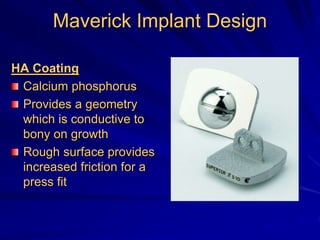 Maverick Implant Design
HA Coating
Calcium phosphorus
Provides a geometry
which is conductive to
bony on growth
Rough surface provides
increased friction for a
press fit
 