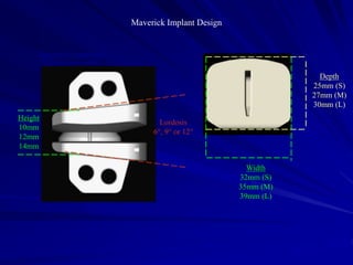 Maverick Implant Design
Inferior Component
Six sizes available:
Width
32mm (S)
35mm (M)
39mm (L)
Superior Component
Eighteen sizes available:
Height
10mm
12mm
14mm
Lordosis
6°, 9° or 12°
Depth
25mm (S)
27mm (M)
30mm (L)
 