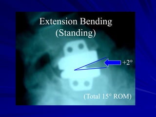 Extension Bending
(Standing)
+2°
(Total 15° ROM)
 