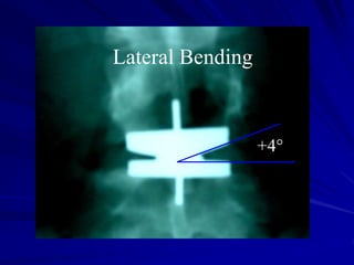 +4°
Lateral Bending
 