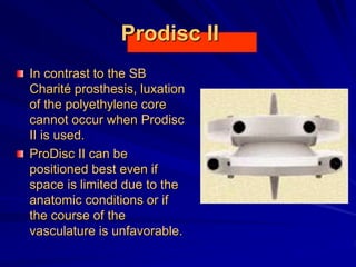 Prodisc II
In contrast to the SB
Charité prosthesis, luxation
of the polyethylene core
cannot occur when Prodisc
II is used.
ProDisc II can be
positioned best even if
space is limited due to the
anatomic conditions or if
the course of the
vasculature is unfavorable.
 