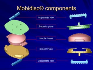 Mobidisc® components
Adjustable keel
Superior plate
Mobile insert
Inferior Plate
Adjustable keel
 