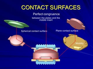 Spherical contact surface Plane contact surface
Perfect congruence
between the plates and the
mobile insert
Mobility
CONTACT SURFACES
 