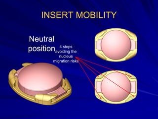 INSERT MOBILITY
Neutral
position 4 stops
avoiding the
nucleus
migration risks
 