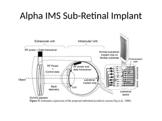 artificial eye ( bionic eye, MARC, epiretinal prosthesis, etc.).pptx