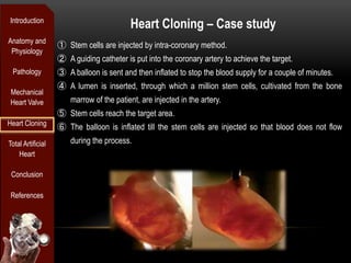 Introduction
                                          Heart Cloning – Case study
Anatomy and
                   ①  Stem cells are injected by intra-coronary method.
 Physiology
                   ②  A guiding catheter is put into the coronary artery to achieve the target.
 Pathology         ③  A balloon is sent and then inflated to stop the blood supply for a couple of minutes.
                   ④  A lumen is inserted, through which a million stem cells, cultivated from the bone
 Mechanical
 Heart Valve           marrow of the patient, are injected in the artery.
                   ⑤  Stem cells reach the target area.
Heart Cloning
                   ⑥  The balloon is inflated till the stem cells are injected so that blood does not flow
Total Artificial       during the process.
    Heart

 Conclusion

 References
 