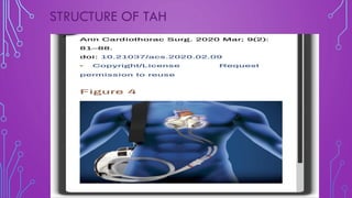 Artificial heart transplantation | PDF