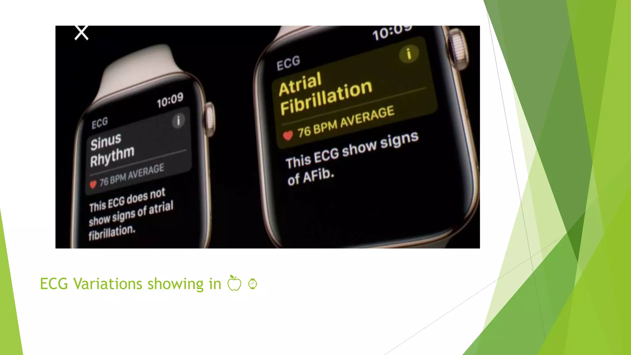 ECG Variations showing in 🍏 ⌚️
 