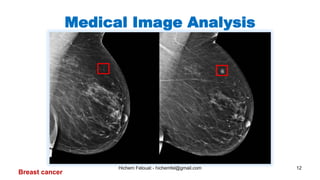 Hichem Felouat - hichemfel@gmail.com 12
Medical Image Analysis
Breast cancer
 