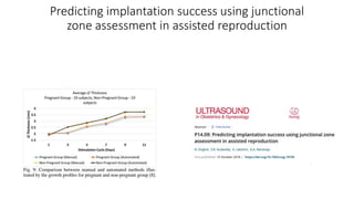 Predicting implantation success using junctional
zone assessment in assisted reproduction
 
