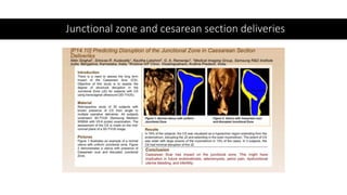 Junctional zone and cesarean section deliveries
 