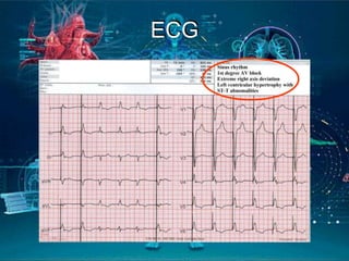 ECG
 