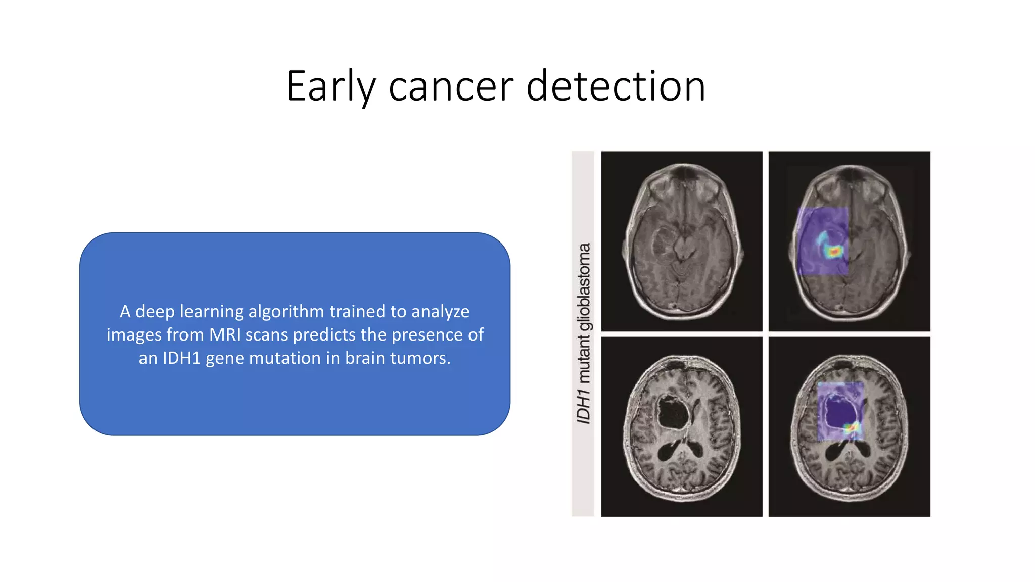 Early cancer detection
A deep learning algorithm trained to analyze
images from MRI scans predicts the presence of
an IDH1 gene mutation in brain tumors.
 