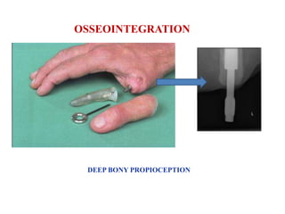OSSEOINTEGRATION

DEEP BONY PROPIOCEPTION

 