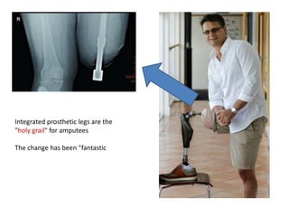 Integrated prosthetic legs are the
"holy grail" for amputees
The change has been "fantastic

 