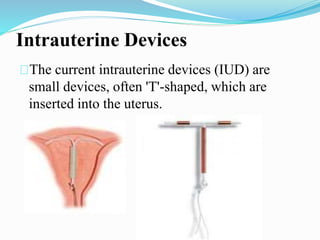 Intrauterine Devices 
The current intrauterine devices (IUD) are 
small devices, often 'T'-shaped, which are 
inserted into the uterus. 
 