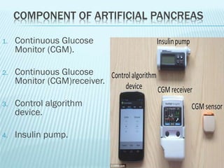 Artificial pancreas | PDF