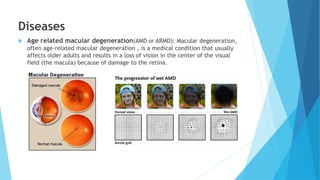 Diseases
 Age related macular degeneration(AMD or ARMD): Macular degeneration,
often age-related macular degeneration , is a medical condition that usually
affects older adults and results in a loss of vision in the center of the visual
field (the macula) because of damage to the retina.
 